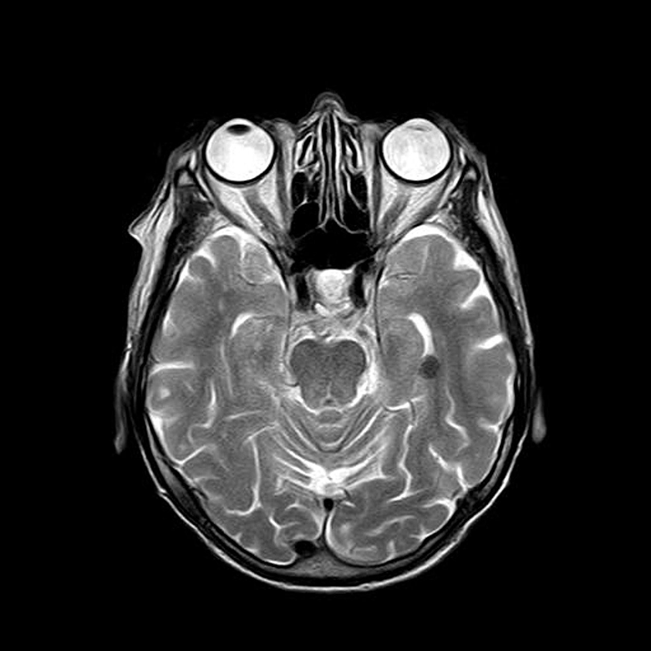 mri, magnetic resonance, roentgen, skull, head, brain, medicine, radiology, examination, check, human, glasses